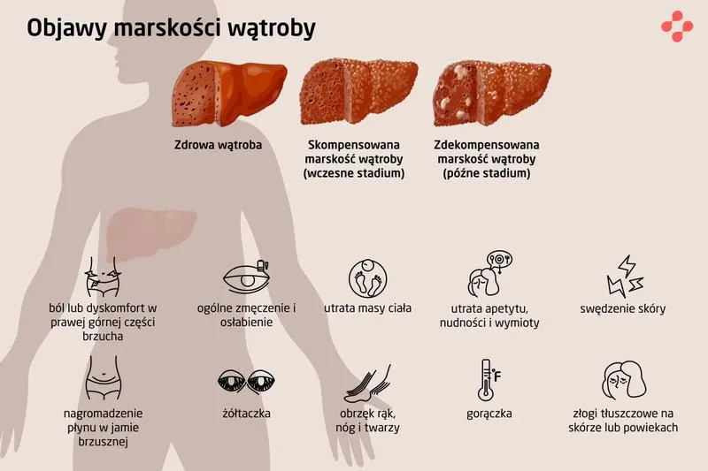 Marskość wątroby – wyrok na życie czy szansa na leczenie?