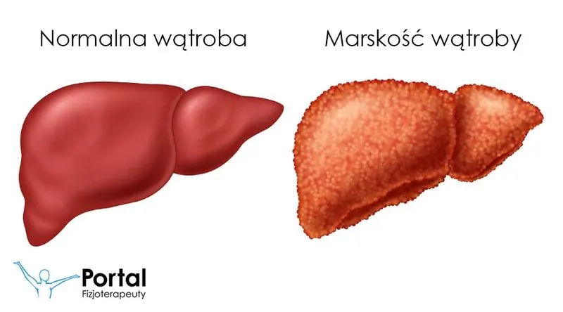Leczenie marskości wątroby i terapie
