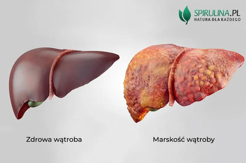 Marskość wątroby przyczyny i objawy